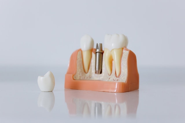 Ile kosztuje ząb wykręcany