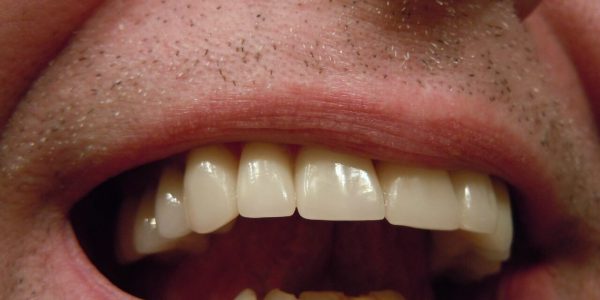 Białe przebarwienia na zębach – jak usunąć