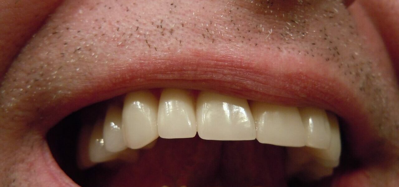 Przebarwienia na zębach przyczyny